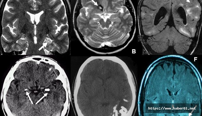 Temporal Lob Epilepsi nedir? Temporal Lob Epilepsi belirtileri nelerdir?