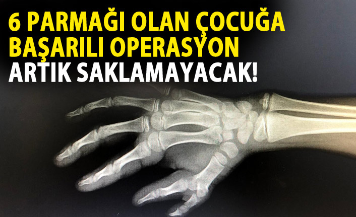 Başparmak fazlalığı olan çocuk sağlığına kavuştu.