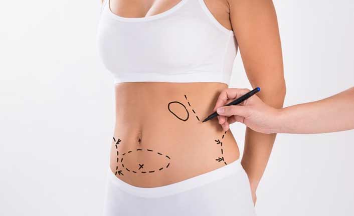 İşte  Liposuction hakkında merak edilenler