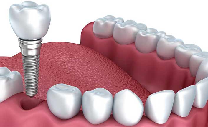 İmplant tedavisinde mutlaka uyulması gereken kurallar...
