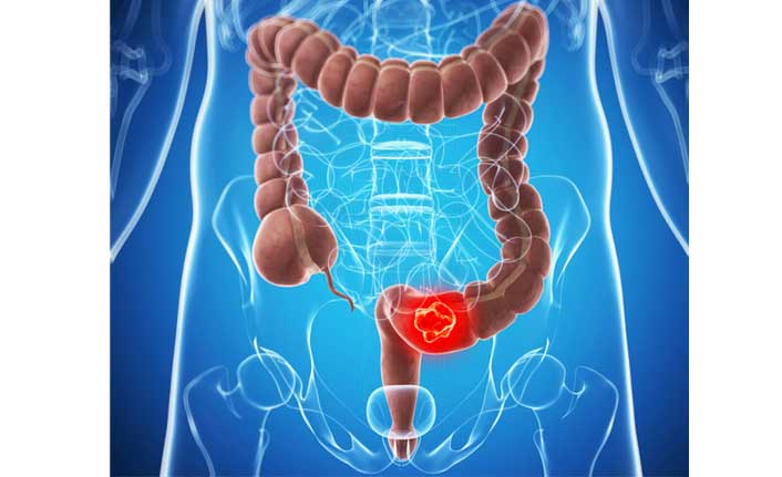 Kolon kanserinde erken teşhis önemli!
