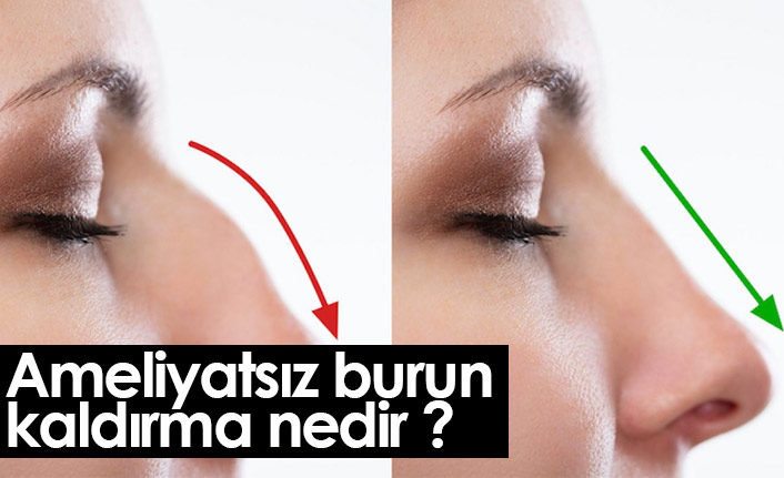 Ameliyatsız burun kaldırma nedir ? Ameliyatsız burun kaldırma nasıl yapılır?