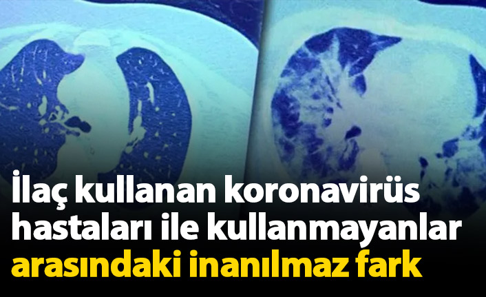 İlaç kullanan koronavirüs hastaları ile kullanmayanlar arasındaki inanılmaz fark