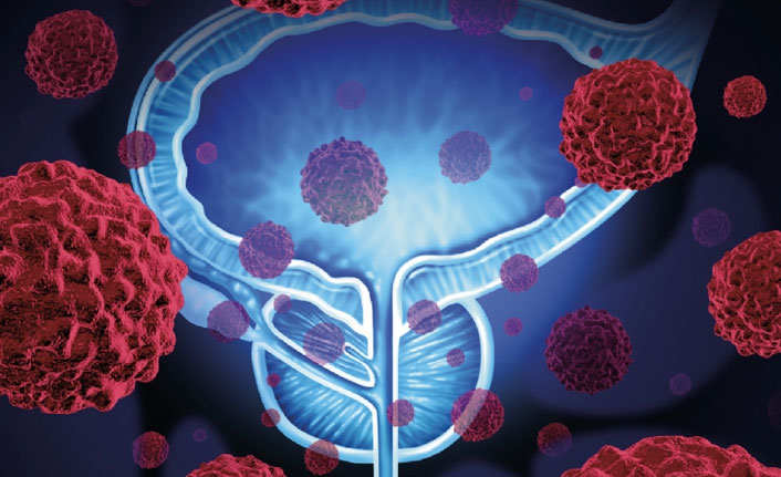“Prostat kanserinde kilo artışı hastalık tekrarına yol açıyor”