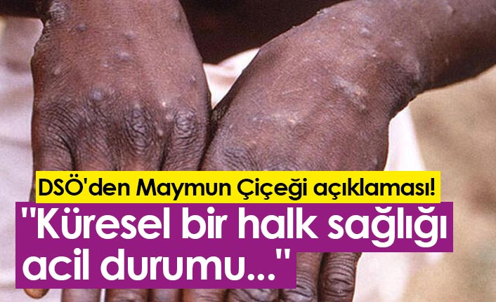 DSÖ'den Maymun Çiçeği açıklaması! "Küresel bir halk sağlığı acil durumu..."