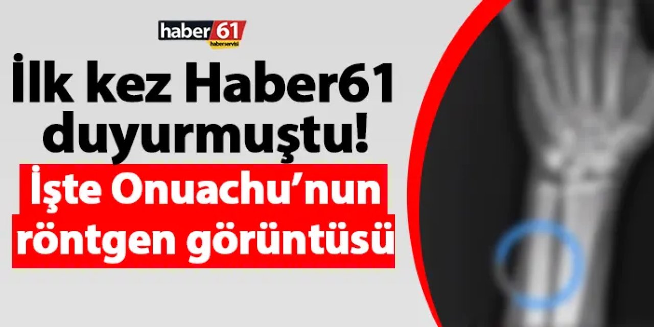 İlk kez Haber61 açıklamıştı! İşte Onuachu’nun röntgen görüntüsü