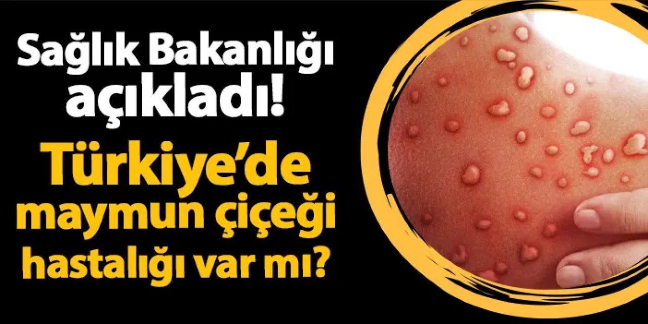 Sağlık Bakanlığı açıkladı! Türkiye'de maymun çiçeği hastalığı var mı?