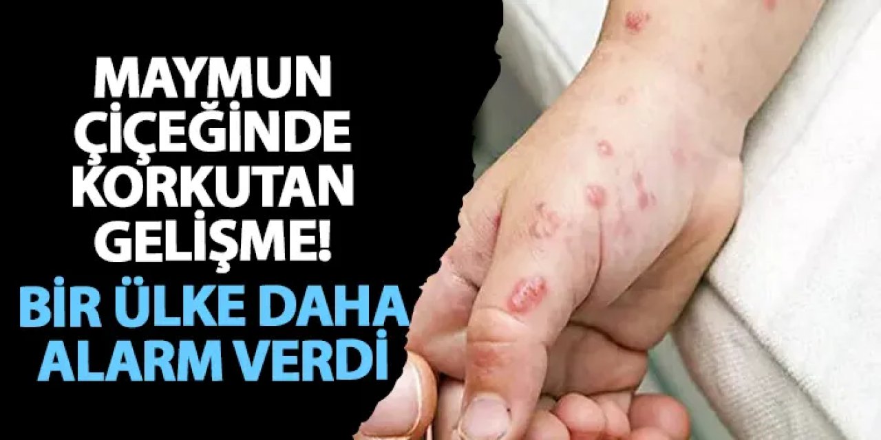 Maymun çiçeğinde korkutan gelişme! Bir ülke daha alarm verdi