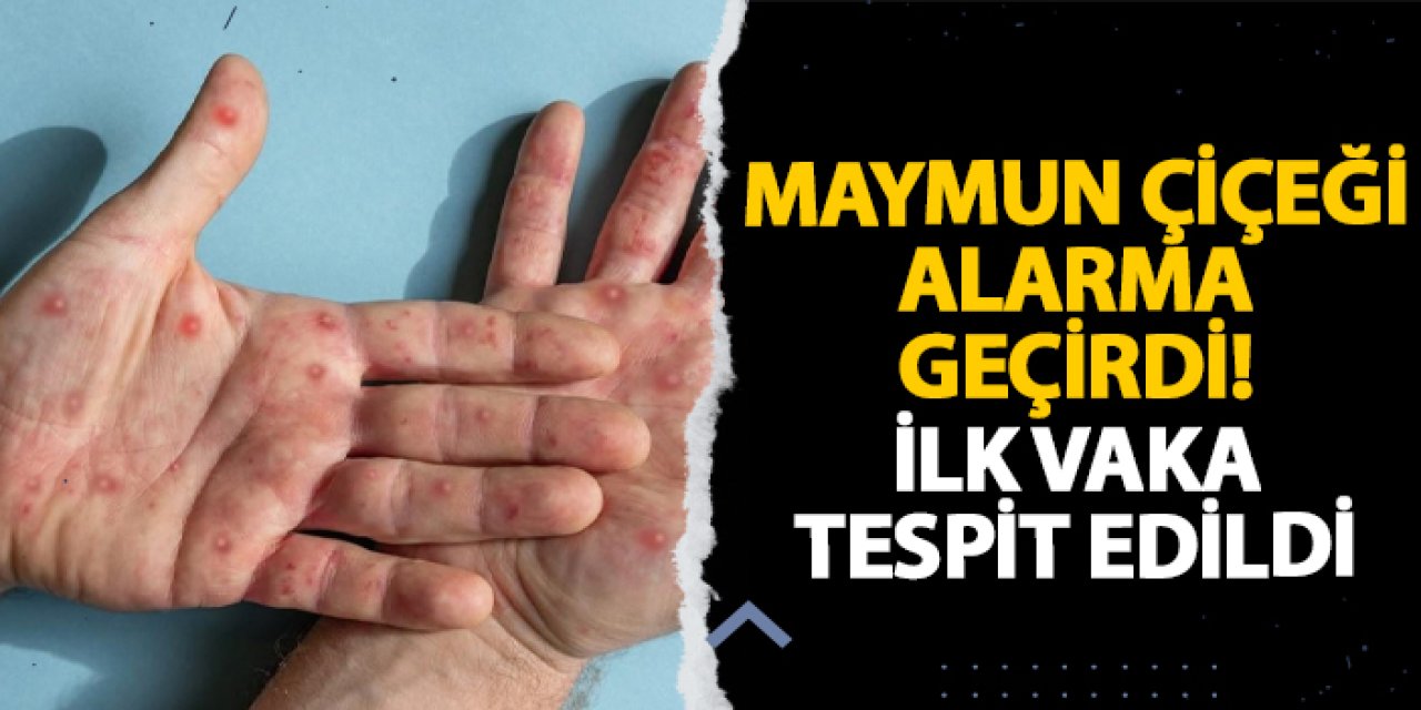 Maymun Çiçeği alarma geçirdi! İlk vaka tespit edildi