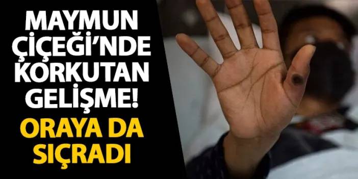 Maymun Çiçeği’nde korkutan gelişme! Oraya da sıçradı