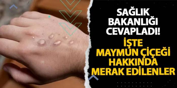 Sağlık Bakanlığı cevapladı! İşte Maymun Çiçeği hakkında merak edilenler