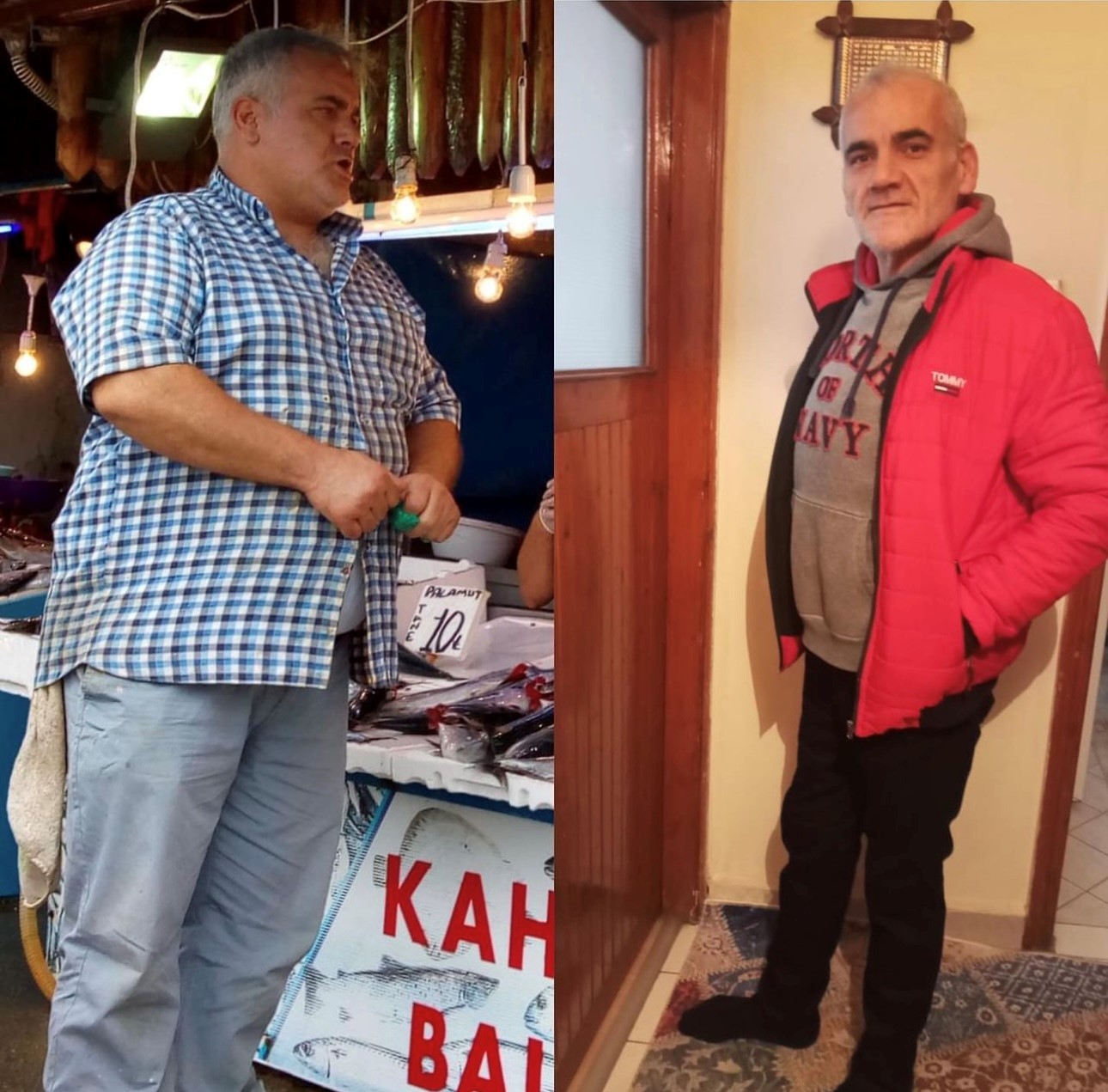 Trabzon'da tüp mide ameliyatı ile hayatı değişti